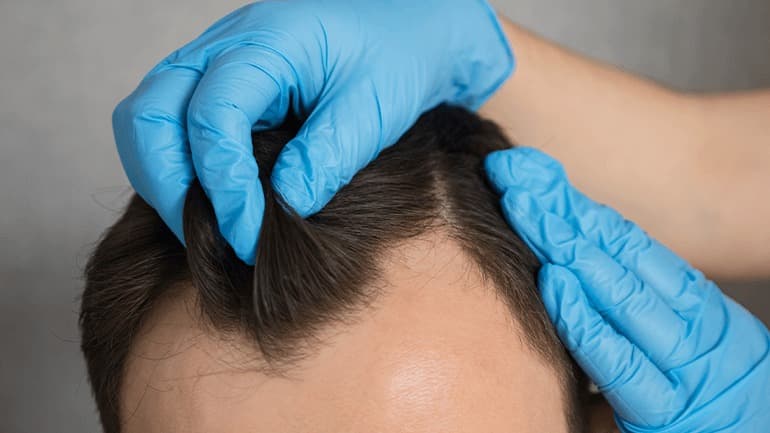 Hair Transplant Turkey: How to Achieve a Permanent Solution