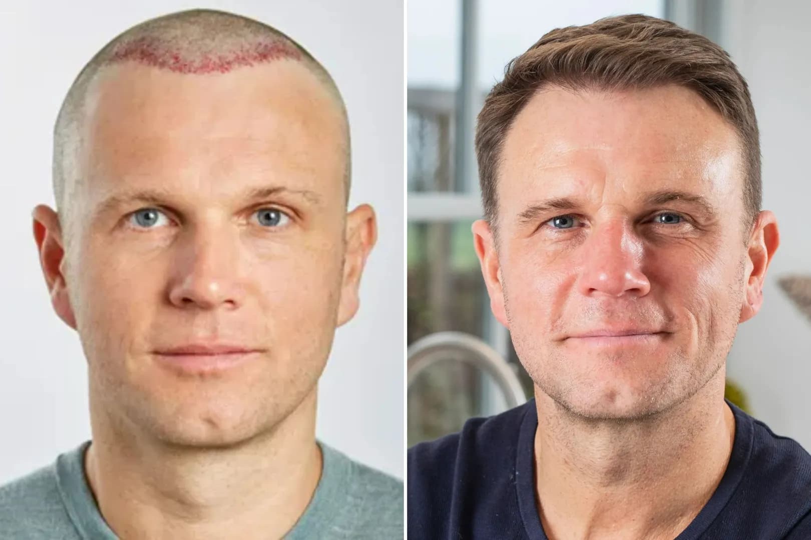Hair Transplant UK Before and After – Real Results, Real Patients