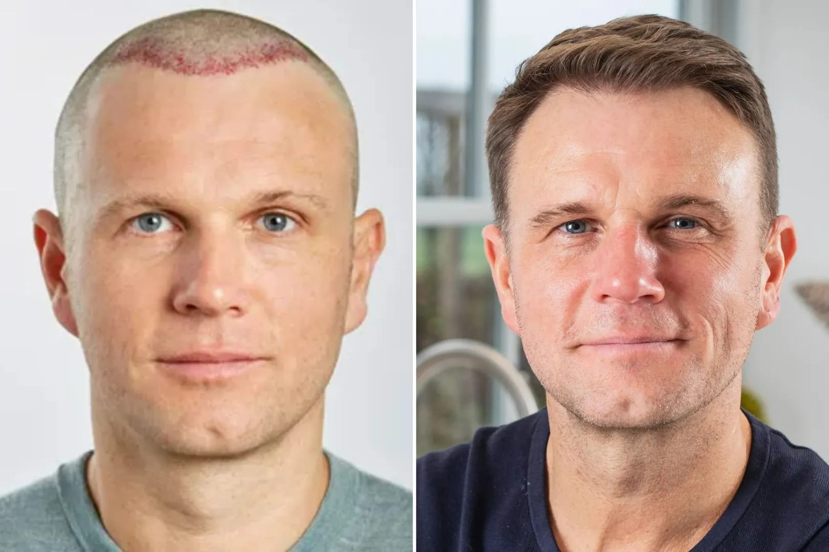 Hair Transplant UK Before and After – Real Results, Real Patients